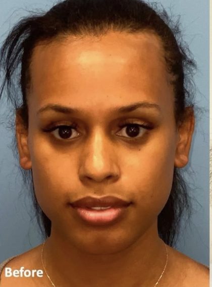 Rhinoplasty Before & After Patient #2185