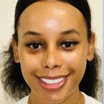 Rhinoplasty Before & After Patient #2185