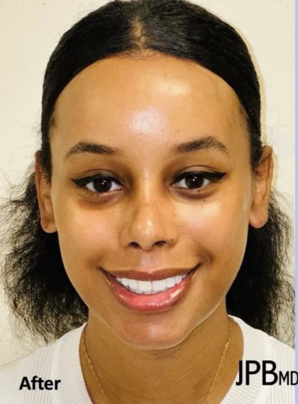 Rhinoplasty Before & After Patient #2185
