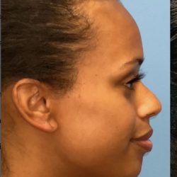 Rhinoplasty Before & After Patient #2185