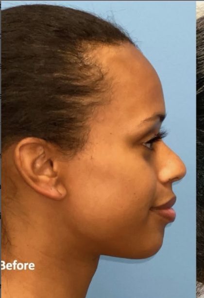 Rhinoplasty Before & After Patient #2185