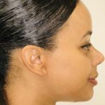 Rhinoplasty Before & After Patient #2185