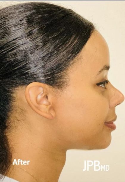 Rhinoplasty Before & After Patient #2185