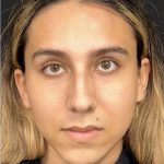 Rhinoplasty Before & After Patient #2186