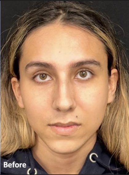 Rhinoplasty Before & After Patient #2186