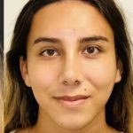 Rhinoplasty Before & After Patient #2186