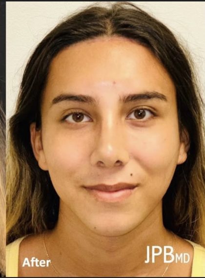 Rhinoplasty Before & After Patient #2186