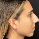 Rhinoplasty Before & After Patient #2186