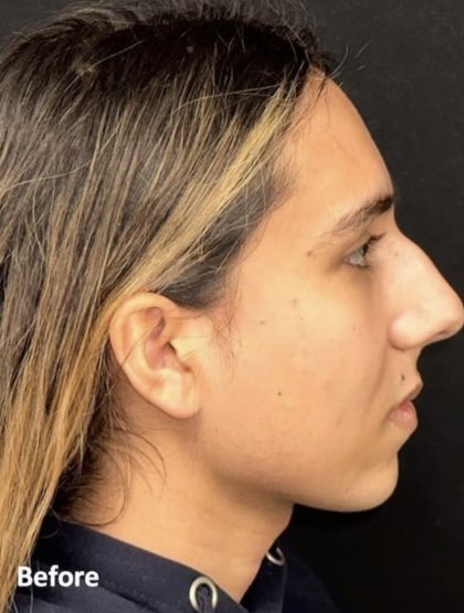 Rhinoplasty Before & After Patient #2186