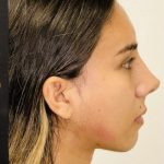 Rhinoplasty Before & After Patient #2186