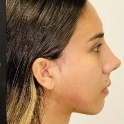 Rhinoplasty Before & After Patient #2186