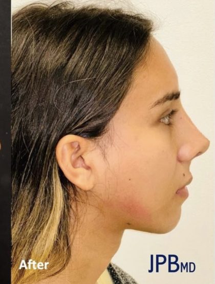 Rhinoplasty Before & After Patient #2186