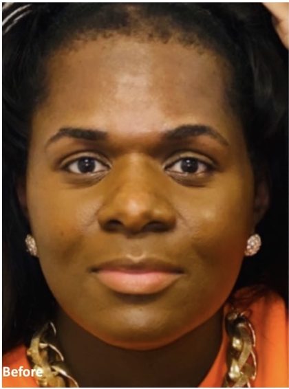 Rhinoplasty Before & After Patient #2187