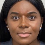 Rhinoplasty Before & After Patient #2187