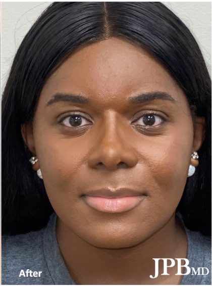 Rhinoplasty Before & After Patient #2187