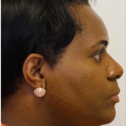 Rhinoplasty Before & After Patient #2187