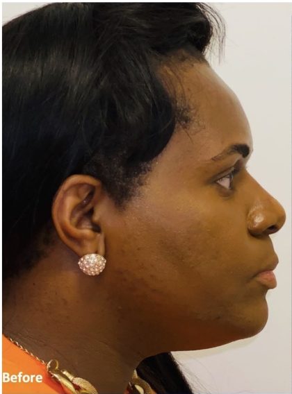 Rhinoplasty Before & After Patient #2187
