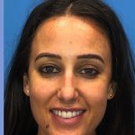 Rhinoplasty Before & After Patient #2179