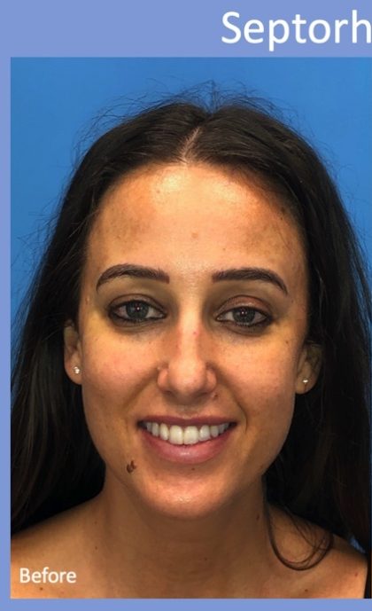 Rhinoplasty Before & After Patient #2179