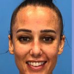 Rhinoplasty Before & After Patient #2179