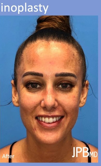 Rhinoplasty Before & After Patient #2179