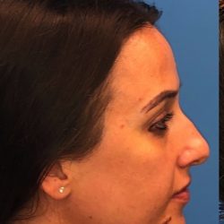 Rhinoplasty Before & After Patient #2179