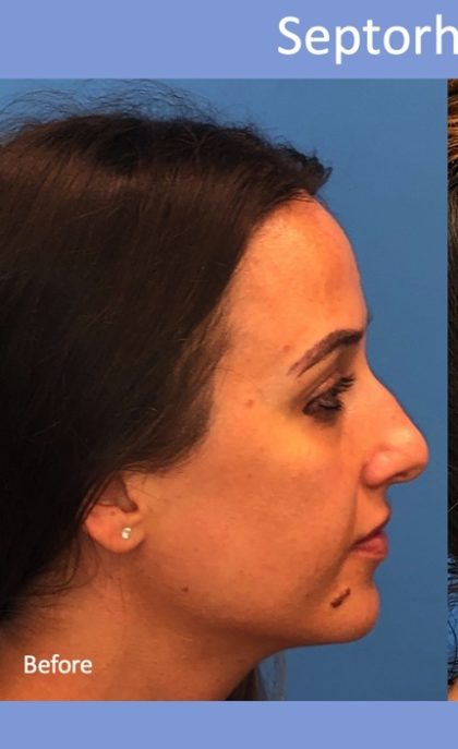 Rhinoplasty Before & After Patient #2179