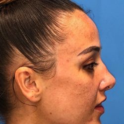Rhinoplasty Before & After Patient #2179