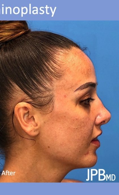 Rhinoplasty Before & After Patient #2179