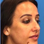 Rhinoplasty Before & After Patient #2179