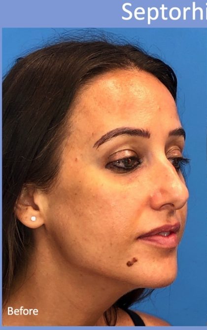 Rhinoplasty Before & After Patient #2179