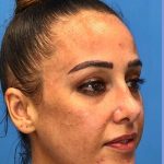 Rhinoplasty Before & After Patient #2179
