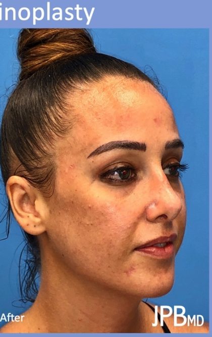 Rhinoplasty Before & After Patient #2179