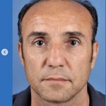 Rhinoplasty Before & After Patient #2188