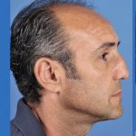 Rhinoplasty Before & After Patient #2188