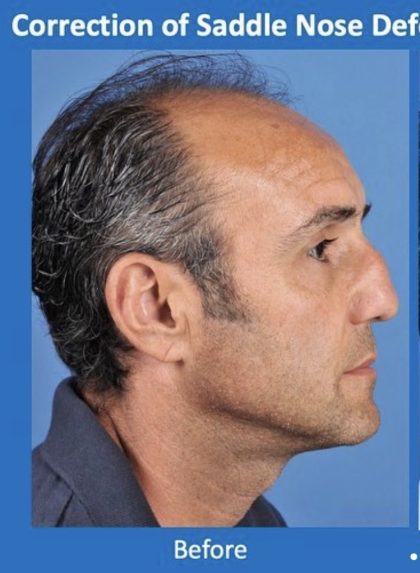 Rhinoplasty Before & After Patient #2188