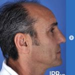Rhinoplasty Before & After Patient #2188