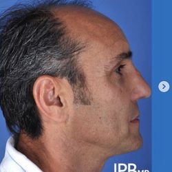 Rhinoplasty Before & After Patient #2188