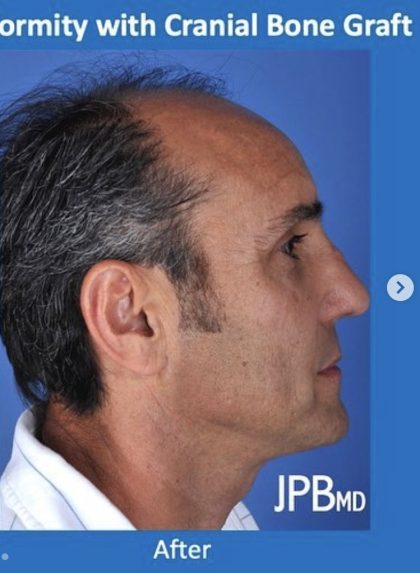 Rhinoplasty Before & After Patient #2188