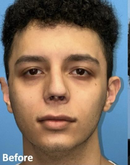 Rhinoplasty Before & After Patient #2189