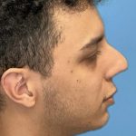 Rhinoplasty Before & After Patient #2189