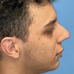 Rhinoplasty Before & After Patient #2189