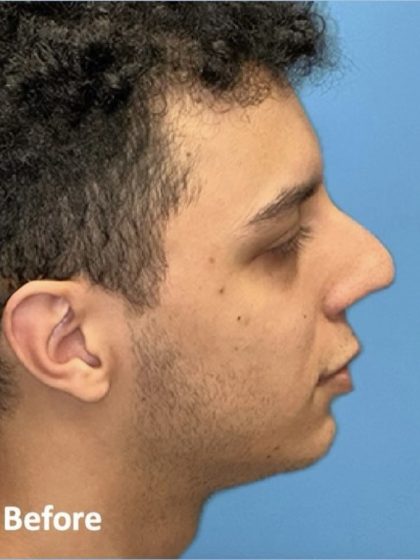 Rhinoplasty Before & After Patient #2189