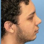 Rhinoplasty Before & After Patient #2189