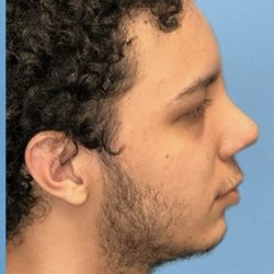 Rhinoplasty Before & After Patient #2189