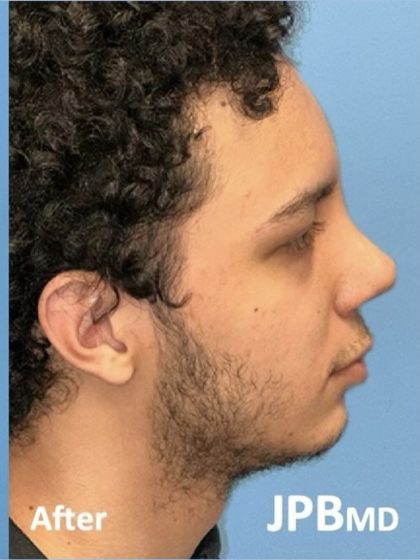 Rhinoplasty Before & After Patient #2189