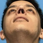 Rhinoplasty Before & After Patient #2189