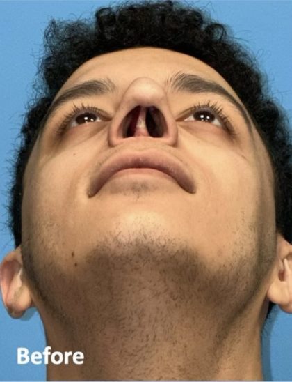 Rhinoplasty Before & After Patient #2189