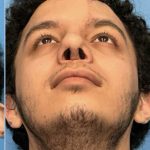 Rhinoplasty Before & After Patient #2189
