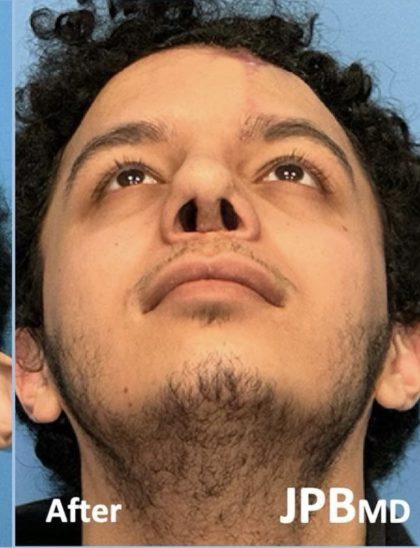 Rhinoplasty Before & After Patient #2189